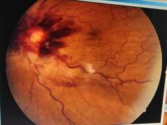 ब्लैक फंगस के बाद आई ऑप्टिक न्यूराइटिस नाम की बीमारी, यहां मिला पहला मामला