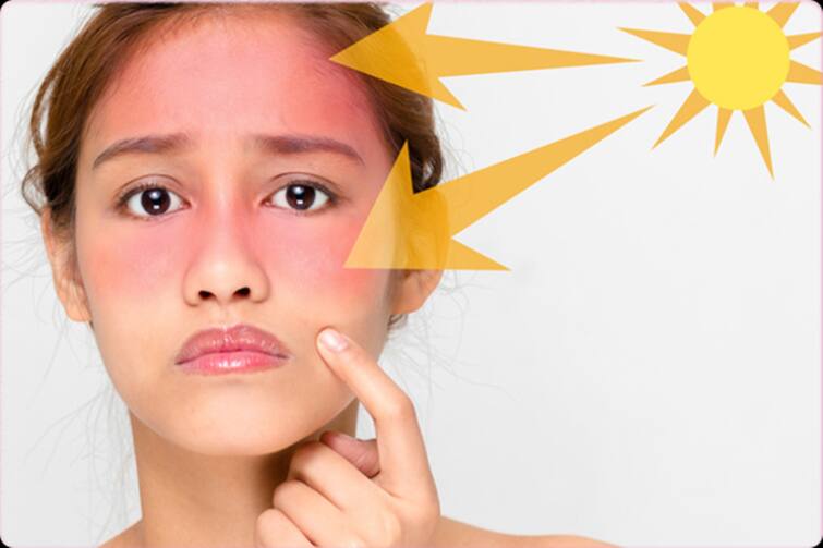 How to Manage Hyperpigmentation in the Summer லாக்டவுன் முடிந்து வெளியே வர்றீங்களா... வெயிலில் சருமத்தை  பாதுகாக்க டிப்ஸ் இதோ!
