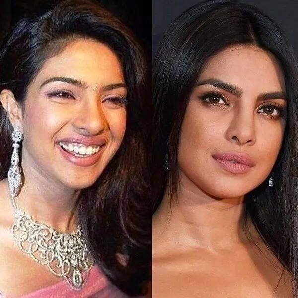 प्रियंका ने अपनी किताब 'अनफिनिश्ड' में जिक्र किया कि उनकी नाक की सर्जरी गलत हो गई थी, जिसके बाद उन्हें कुछ फ़िल्में नहीं मिल पाई थीं. इस सर्जरी के बाद उनका लुक काफी बदल गया था.