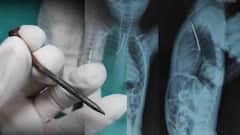 এসএসকেএমে জটিল অস্ত্রোপচারে বাঁচল শিশুর প্রাণ