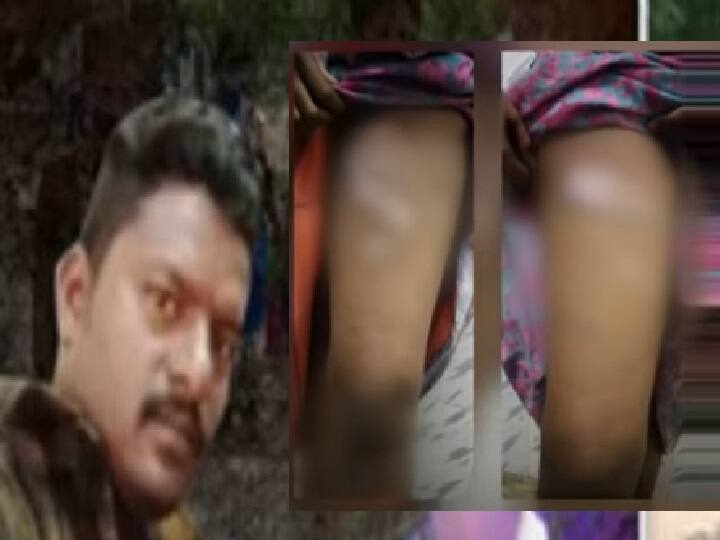 Husband harasses wife by brutally heating up 16 places of her body in Dharmapuri மார்பு.. அந்தரங்கப்பகுதி..  16 இடங்களில் சூடு வைத்த கொடூர கணவன் - தப்பித்து ஓடிவந்த  மனைவி..!