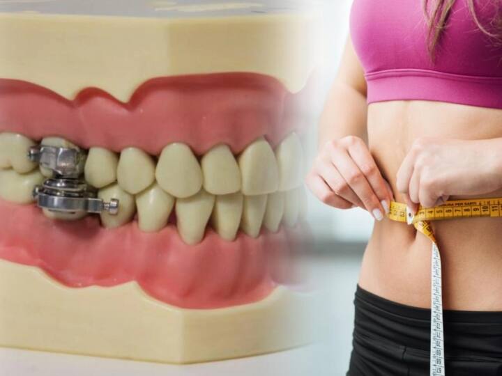 New weight-loss tool prevents mouth from opening more than 2mm இதுக்கு மேல வாயைத் திறக்காத... வெயிட்டைக் குறைக்க புது ரூட்டு!