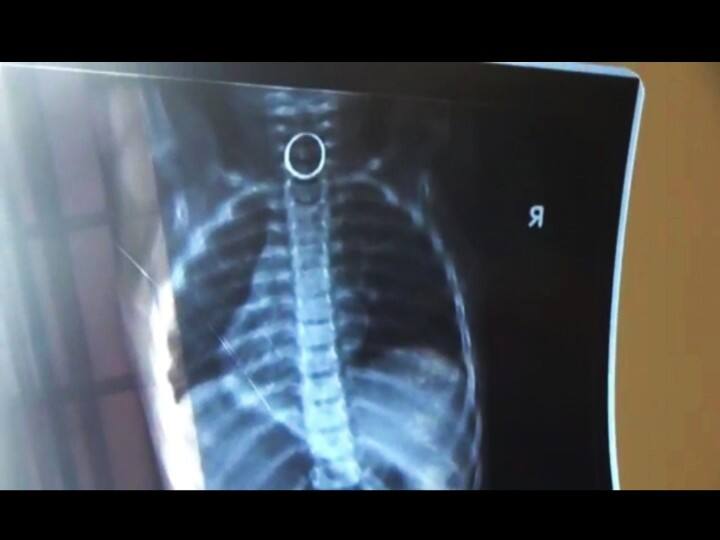 Sivagangai Hospital has removed a gold ring stuck in a child's throat குழந்தை தொண்டையில் சிக்கிய தங்க மோதிரம்; போராடி காப்பாற்றிய அரசு மருத்துவர்கள்!