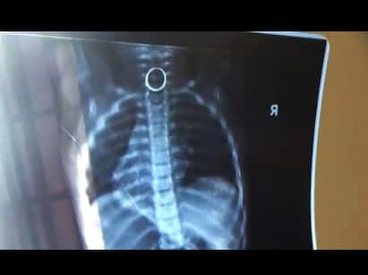 Sivagangai Hospital has removed a gold ring stuck in a childs throat குழந்தை தொண்டையில் சிக்கிய தங்க மோதிரம் போராடி காப்பாற்றிய அரசு மருத்துவர்கள்!