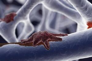 અવૈસ્કુલર નેકોસિસના મુંબઇમાં ત્રણ કેસ નોંધાય છે. ડોક્ટર્સ એ વાતને લઇને ચિંતિત છે કે, આવનાર સમયમાં અવૈસ્કુલર નેકોસિસના કેસ વધી શકે છે. આ સમસ્યા માટે સ્ટીરોઇડને વધુ જવાબદાર મનાય છે એટલે કે, બીમારીથી બહાર આવવા માટે અપાતી સ્ટીરોઇડના કારણે અવૈસ્કુલર નેકોસિસની સમસ્યા થઇ શકે છે.