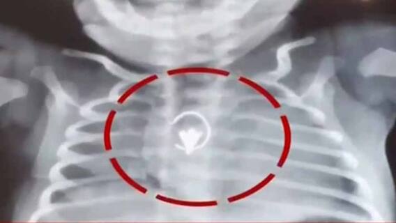 SSKM: ২৮ দিনের শিশুর শ্বাসনালী থেকে বের করা হল নাকছাবি, জটিল অস্ত্রোপচার এসএসকেএমে