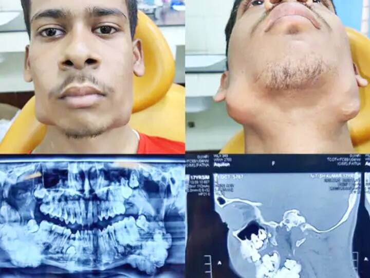 17 year old boy have 82 teeth in his mouth for the first time in IGIMS doctors were also surprised to see ann