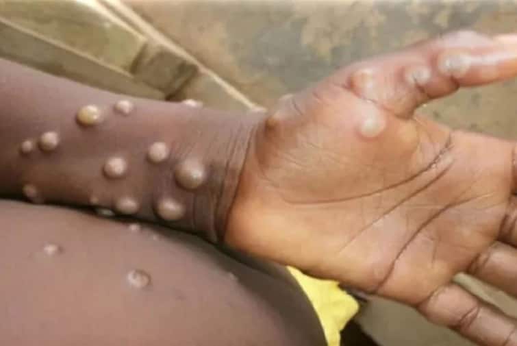 Mokneypox Virs: Know what WHO said on spread of monkeypox virus out side Africa check details Monkeypox Virus: ટ્રાવેલ હિસ્ટ્રી વગર આફ્રિકાથી બહાર કેવી રીતે ફેલાઈ રહ્યો છે મંકીપોક્સ ? WHO એ આપ્યો જવાબ