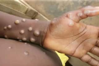 Monkeypox Virus: ટ્રાવેલ હિસ્ટ્રી વગર આફ્રિકાથી બહાર કેવી રીતે ફેલાઈ રહ્યો છે મંકીપોક્સ ? WHO એ આપ્યો જવાબ