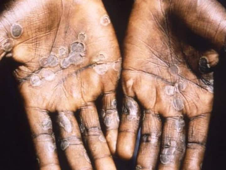 First Case Of Rare 'Monkeypox' Registered In USA, First Time In 20 Years First Case Of Rare 'Monkeypox' Registered In USA, First Time In 20 Years