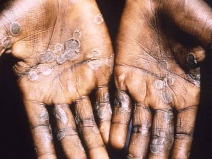 Monkeypox in US: अमेरिका के टेक्सास में दुर्लभ ‘मंकीपॉक्स’ का पहला मामला दर्ज, 20 सालों में पहली बार हुआ ऐसा
