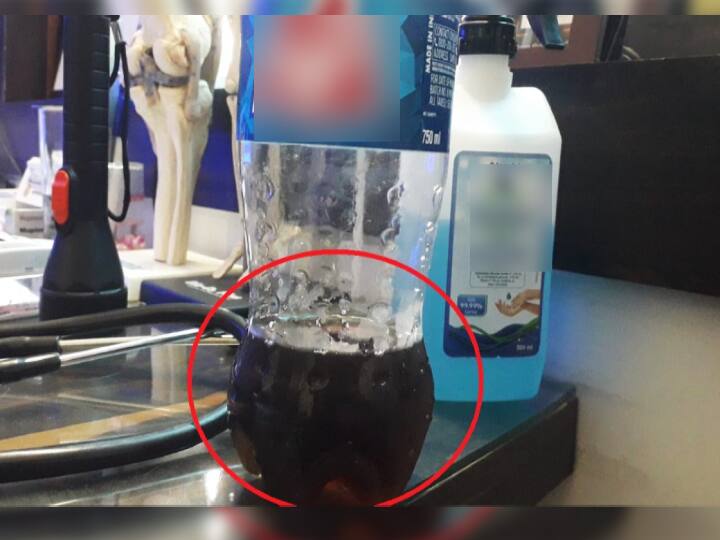 OMG! गोपालगंज में कोल्ड ड्रिंक समझ कर तेजाब के पानी को गटक गया डॉक्टर, जलने लगा मुंह