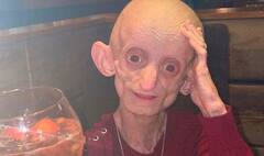 18 વર્ષની ઉંમરમાં 144 વર્ષની દેખાતી હતી આ યુવતી, ‘પા’ ફિલ્મ જેવી બીમારીથી હતી પીડિત