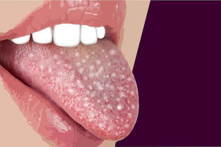 what is the meaning of white tongue in health concerns White Tongue: जीभ क्यों दिखने लगती है सफेद, क्या होते हैं इसके मायने?