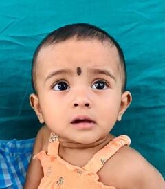 पायातील हाडाच्या साहाय्याने दूर केले लहान मुलीच्या जबड्याचे व्यंग