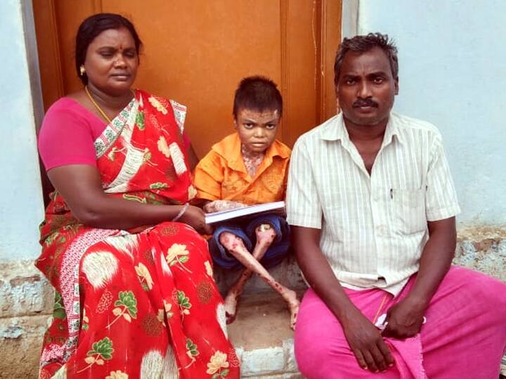 A boy suffering from a strange skin disease due to a deficiency of genes near Palani ஜீன்கள் குறைப்பாட்டால் ஏற்பட்ட வினோத நோயால் அவதிப்படும் 13 வயது சிறுவன் - அரசு உதவ கோரிக்கை