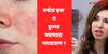 Skin Problem In Monsoon: সারা গায়ে র‍্যাশ? মাথা চুলকে নাজেহাল? বর্ষার বিড়ম্বনা এড়াতে কী করবেন?