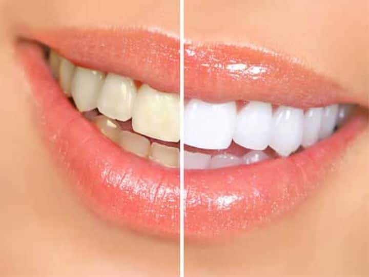 Home Remedies For Teeth Whitening How To Clean Yellow Teeth Use Mustard Oil And Get Strong And Shiny Teeth पीले से पीले दांत भी चमकने लगेंगे, आयुर्वेद में दांतों के लिए वरदान माना गया है सरसों का तेल, इस तरह करें इस्तेमाल