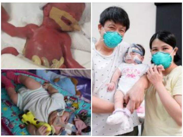 World's Smallest Baby' Goes Home After 13 Months stay In Hospital know what is case 13 महीने अस्पताल में बिताकर घर पहुंचा 'दुनिया का सबसे छोटा मासूम' जानिए क्या है पूरा मामला