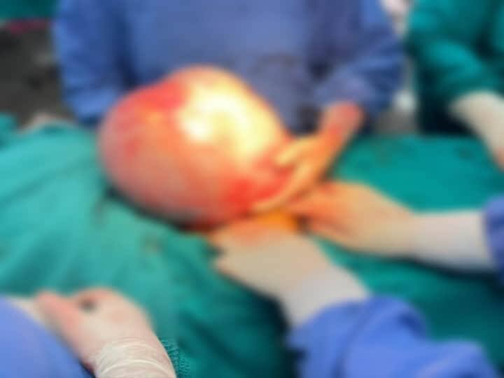 Doctors Remove 7-kg Tumour From 29-Year-Old Woman's Abdomen In Madurai Doctors Remove 7-kg Tumour From 29-Year-Old Woman's Abdomen In Madurai