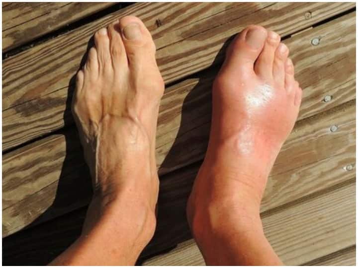 out of control uric acid can lead to Gout Here are natural ways to lower level यूरिक एसिड बढ़ने से हो सकती है पैरों  में ये बड़ी समस्या, इस तरह कम करें लेवल