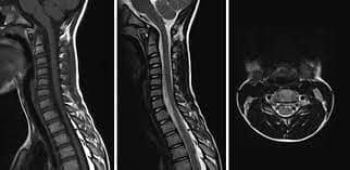 US Health Department warns of New Outbreak of Polio-like illness in children later this year New Illness in Children আগামী চারমাসে মার্কিন শিশুদের মধ্যে পোলিও-জাতীয় রোগের প্রাদুর্ভাব বাড়বে, সতর্ক করল সেদেশের স্বাস্থ্য দফতর