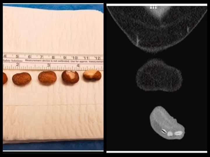 Young man from Michigan put 6 kidney beans into his urethra and causes displeasure to his urinary bladder விளையாட்டு விபரீதத்தில் முடிந்தது-சிறுநீர் குழாய்க்குள் 6 சிவப்பு காராமணி போட்ட இளைஞர்!