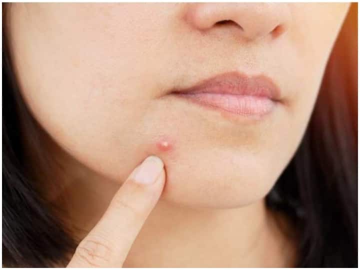 Skin Care Tips, Eat These Things to get Rid of Pimples And Pimples Reducing Diet  Skin Benefits Of Pumpkin Seeds Beetroot And Curd Skin Care Tips: अगर आपको पाना है Pimples से छुटकारा, तो खाएं ये चीजें