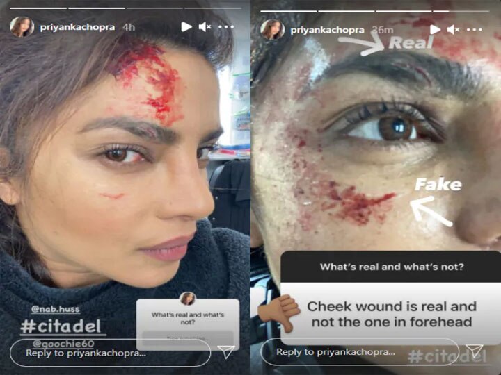 Priyanka Chopra को शूटिंग के दौरान लगी 'चोट', फैन्स हुए परेशान