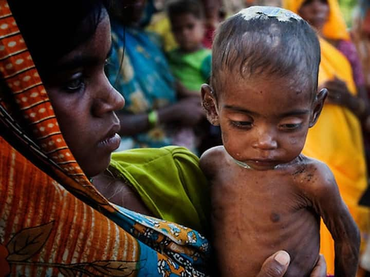 MP News: More than 10 lakh children are malnourished ANN MP News: तमाम अभियान चलाने के बाद भी नाकामी लगी हाथ, मध्य प्रदेश में 10 लाख से ज्यादा बच्चे हैं कुपोषण के शिकार