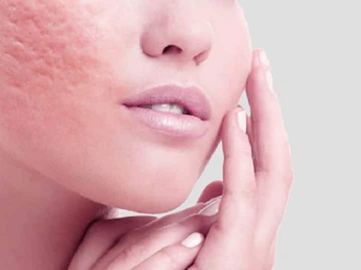 Skin Care Tips: चेहरे के ओपन पोर्स को इन आयुर्वेदिक तरीके से करें बंद