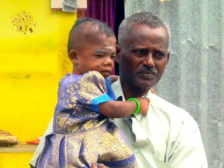 In Dindigul, parents are demanding that the government help a 25-year-old disabled woman with a 2-year-old appearance 2 வயது தோற்றம் கொண்ட 25 வயது மாற்றுத்திறனாளி பெண் - உதவிக்கரம் நீட்ட அரசுக்கு கோரிக்கை...!