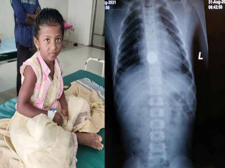 Thiruvannamalai Doctors who saved the little girl who swallowed the coin சிறுமி உணவுக் குழாயில் சிக்கிய ரூ.1 நாணயம்: போராடி மீட்ட டாக்டர்கள்!