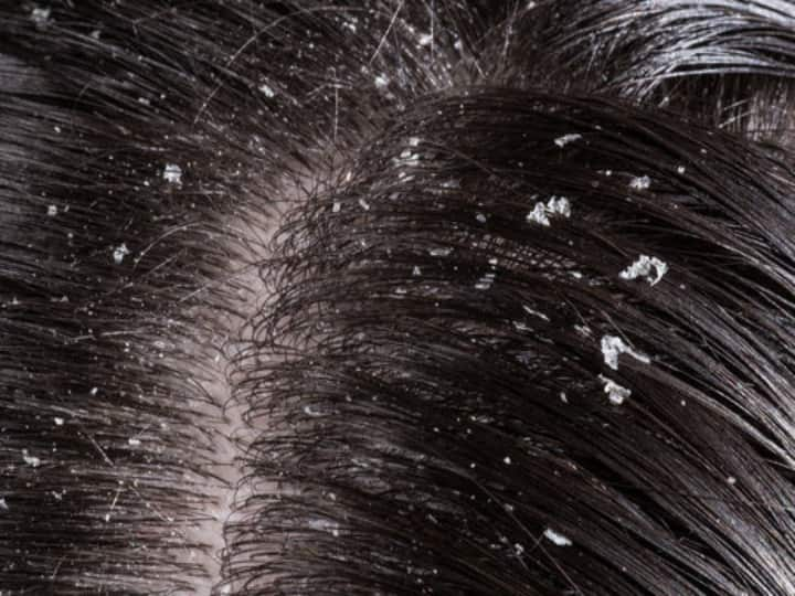 Follow this easy home remedy to get rid of dandruff, hair will also become silky-soft