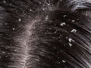 Dandruff Hair Care : कोंडा दूर करण्यासाठी रामबाण उपाय, जाणून घ्या 'या' तीन घरगुती आणि सोप्या टीप्स
