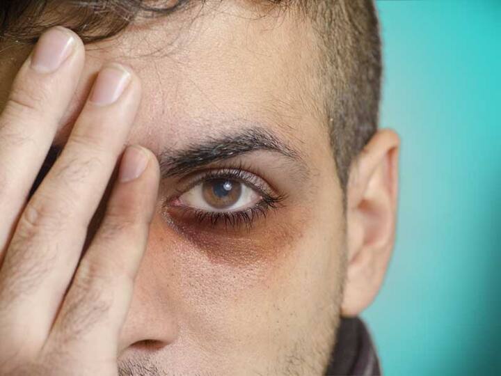 Dark Circles Under The Eyes: Know About The Three Different Types Of Dark Circles And Their Causes Dark Circles | கருவளையம் உண்டாக பல காரணங்கள் இருக்கு.. சரிசெய்ய இதை செய்தாலே போதும்.!