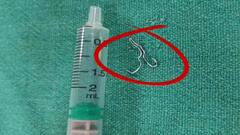 এসএসকেএমে জটিল অস্ত্রোপচার, সদ্যোজাতর খাদ্যনালি থেকে বের করা হল ধাতব হুক