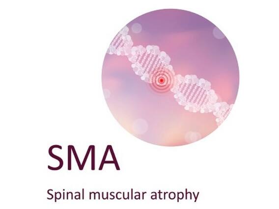 Spinal Muscular Atrophy: Why Early Diagnosis And Treatment Is Crucial For Patients