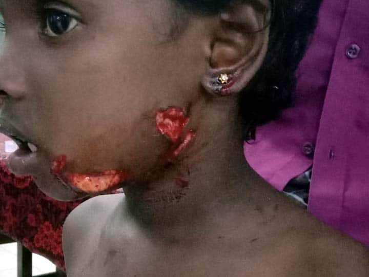 Treatment for 2 children in dog bite near Thiruvaiyaru in Thanjavur district சிறுவனின் ஆண் உறுப்பை கடித்த நாய்கள் - ஆபத்தான நிலையில் மருத்துவமனையில் சிகிச்சை