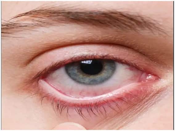 Thyroid Eye Disease: जानिए इसके कारण और लक्षण, इस तरह करें पहचान और इलाज Thyroid Eye Disease: जानिए इसके कारण और लक्षण, इस तरह करें पहचान और इलाज