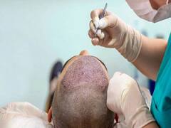 Hair plantation செய்தால் மரணம் நேரிடுமா? எச்சரிக்கையுடன் இருப்பது எப்படி? மருத்துவர்கள் தரும் விளக்கம்!