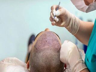 Hair plantation செய்தால் மரணம் நேரிடுமா? எச்சரிக்கையுடன் இருப்பது எப்படி? மருத்துவர்கள் தரும் விளக்கம்!