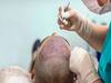 Hair plantation செய்தால் மரணம் நேரிடுமா? எச்சரிக்கையுடன் இருப்பது எப்படி? மருத்துவர்கள் தரும் விளக்கம்!