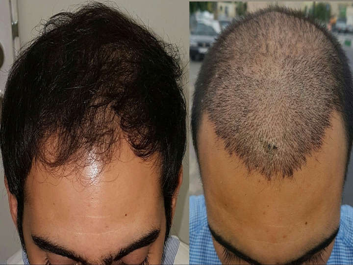 Hair plantation செய்தால் மரணம் நேரிடுமா? எச்சரிக்கையுடன் இருப்பது எப்படி? மருத்துவர்கள் தரும் விளக்கம்!