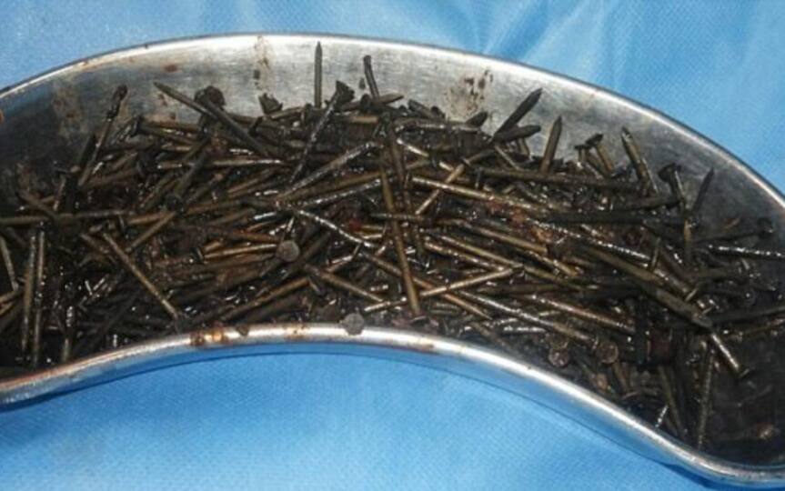 Lithuania Doctors removed a pound of nails from a man’s stomach Lithuania : నెల రోజులుగా మేకులు, బోల్టులే తిన్నాడు ! చివరికేమయిందంటే ?