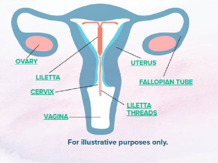 Here's Why Your IUD Might Give You Random Periods, According to a Doctor கருத்தடை சாதனமும், ஒழுங்கற்ற பீரியட்ஸும்.. பெண்களுக்கு இது கண்டிப்பா தெரியணும்..