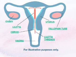 Heres Why Your IUD Might Give You Random Periods, According to a Doctor கருத்தடை சாதனமும், ஒழுங்கற்ற பீரியட்ஸும்.. பெண்களுக்கு இது கண்டிப்பா தெரியணும்..