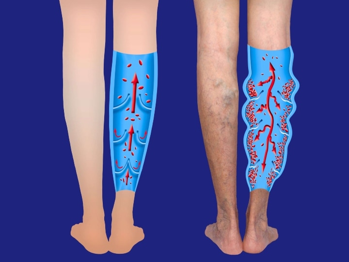 Varicose Veins: ரத்தக் குழாய்களில் தேங்கி சுருண்டு இருக்கும் ‛வெரிகோஸ் வெய்ன்’ பற்றி தெரியுமா ?