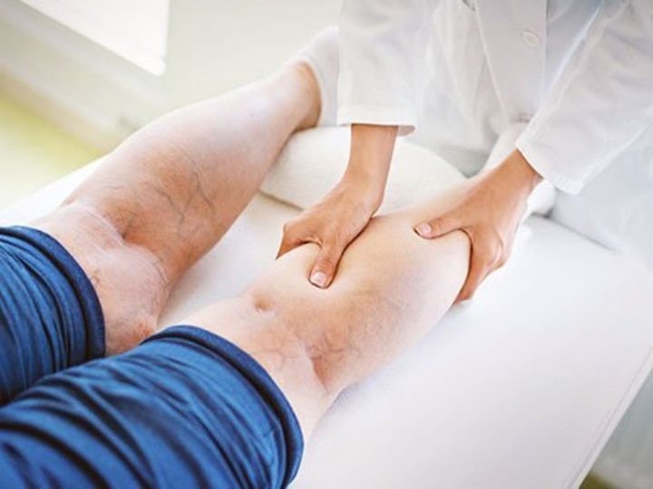 Varicose Veins: ரத்தக் குழாய்களில் தேங்கி சுருண்டு இருக்கும் ‛வெரிகோஸ் வெய்ன்’ பற்றி தெரியுமா ?