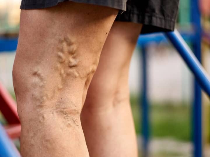 Varicose Veins Causes, symptoms, treatment and prevention All you Need to Know Varicose Veins: ரத்தக் குழாய்களில் தேங்கி சுருண்டு இருக்கும் ‛வெரிகோஸ் வெய்ன்’ பற்றி தெரியுமா ?
